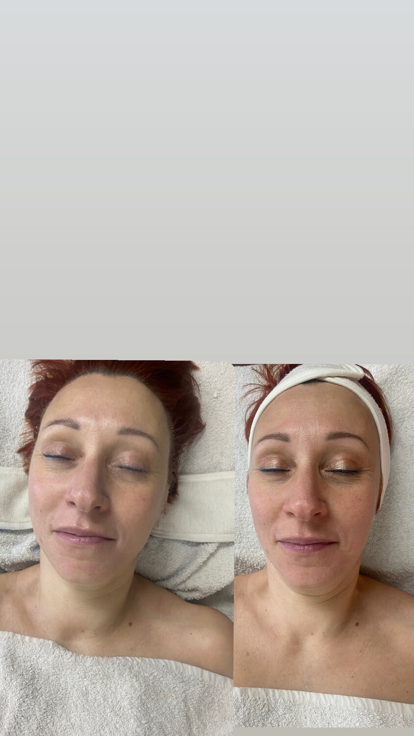 пилинг, процедура, косметолог, косметолог эстетист, косметологии