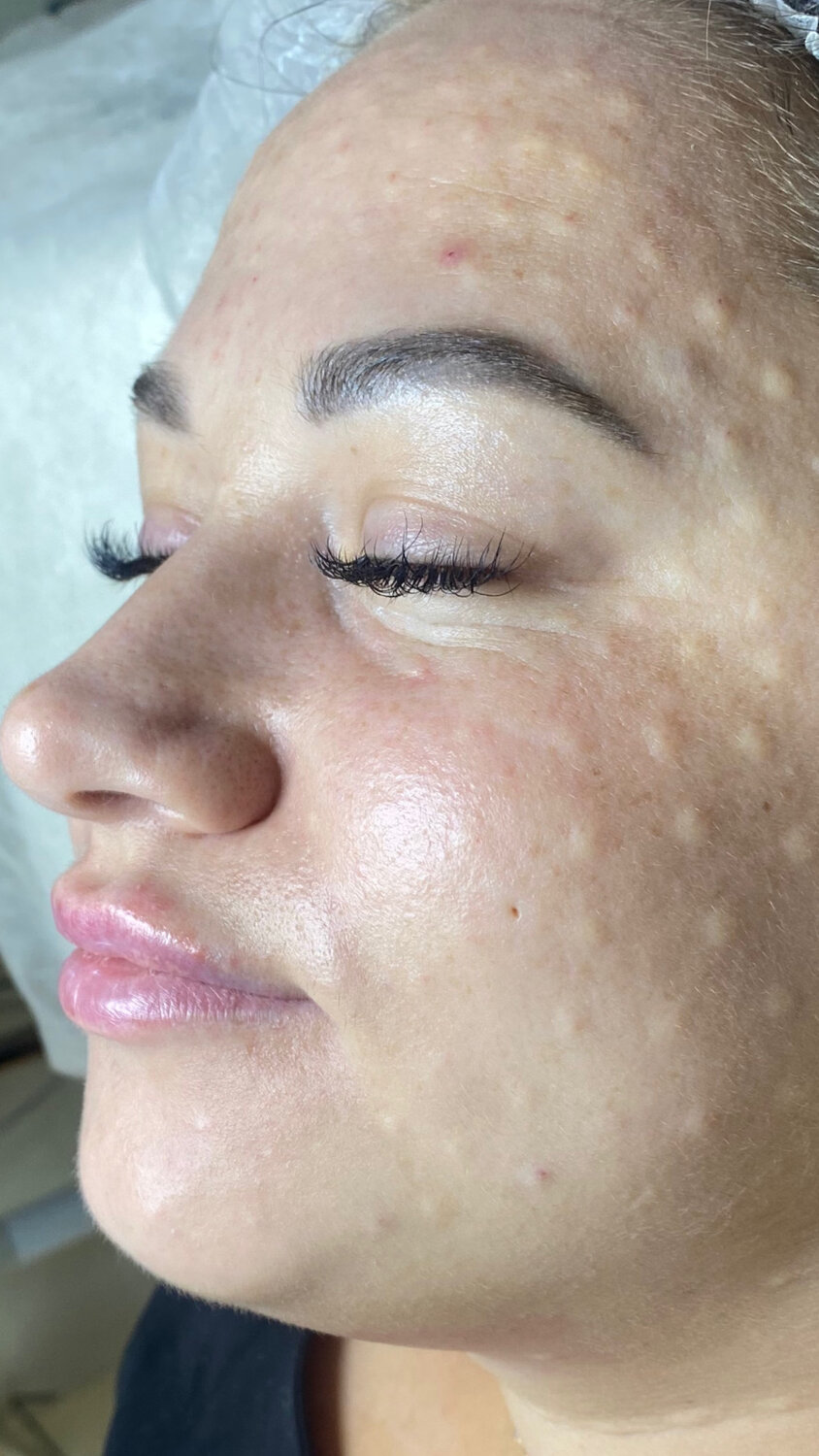 биоревитализация, биоревитализации лица, лицо после биоревитализации, биоревитализации лица до и после эффект, процедура биоревитализации лица