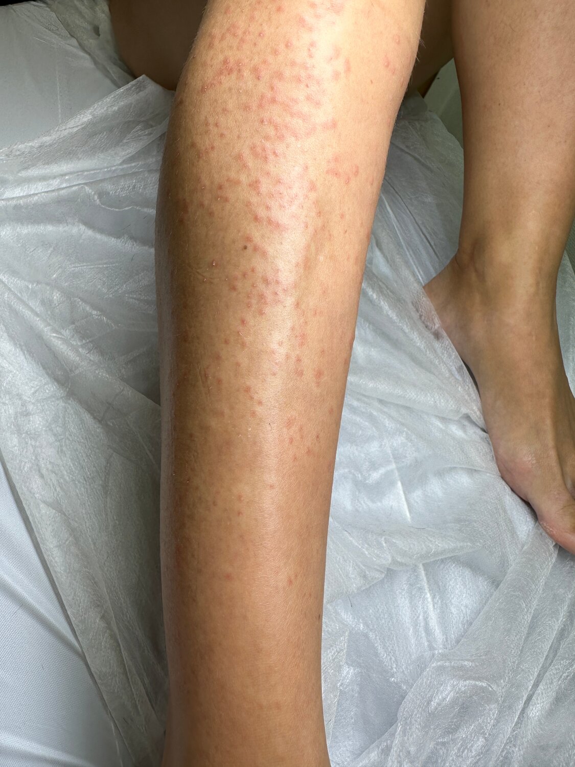 раздражение на ногах, сыпь на ногах, депиляция ног, электроэпиляция, после лазерной эпиляции
