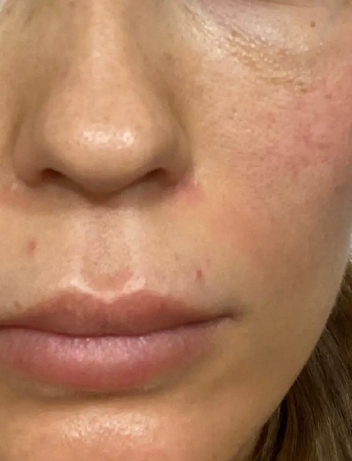 губы, увеличение губ, естественные губы, пластика губ, гиалуроновая кислота