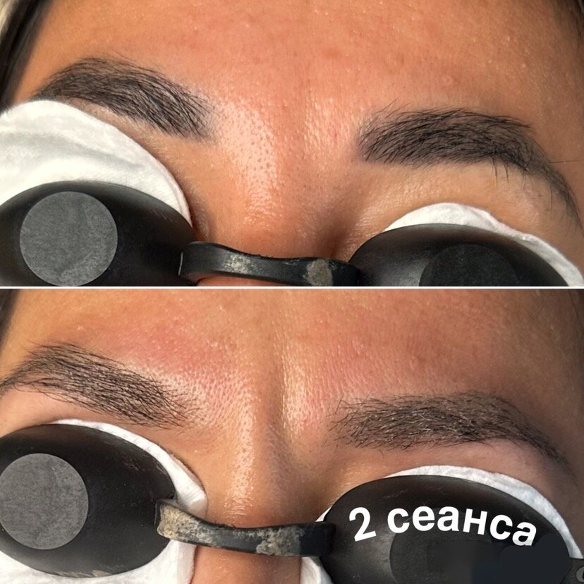 лазерное удаление татуажа, удаление татуажа лазером, удаление татуажа, татуаж, пм бровей