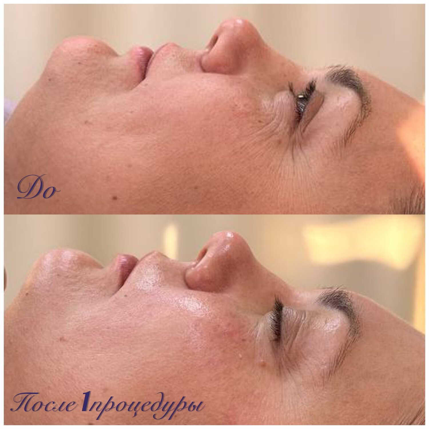 пилинг, пилинг лица, процедуры для лица, чистка лица, пилинг тса