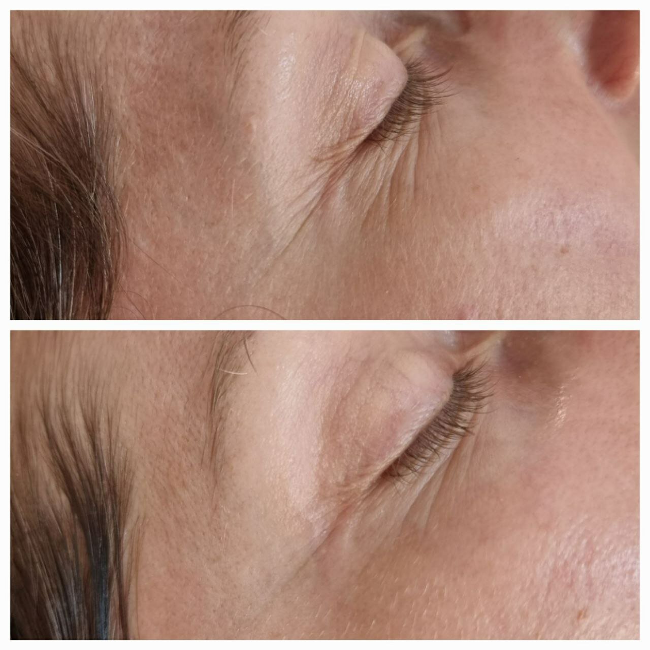 мезотерапия для лица, лифтинг эффект, гиалуроновая кислота, глубокие морщины, разглаживание морщин