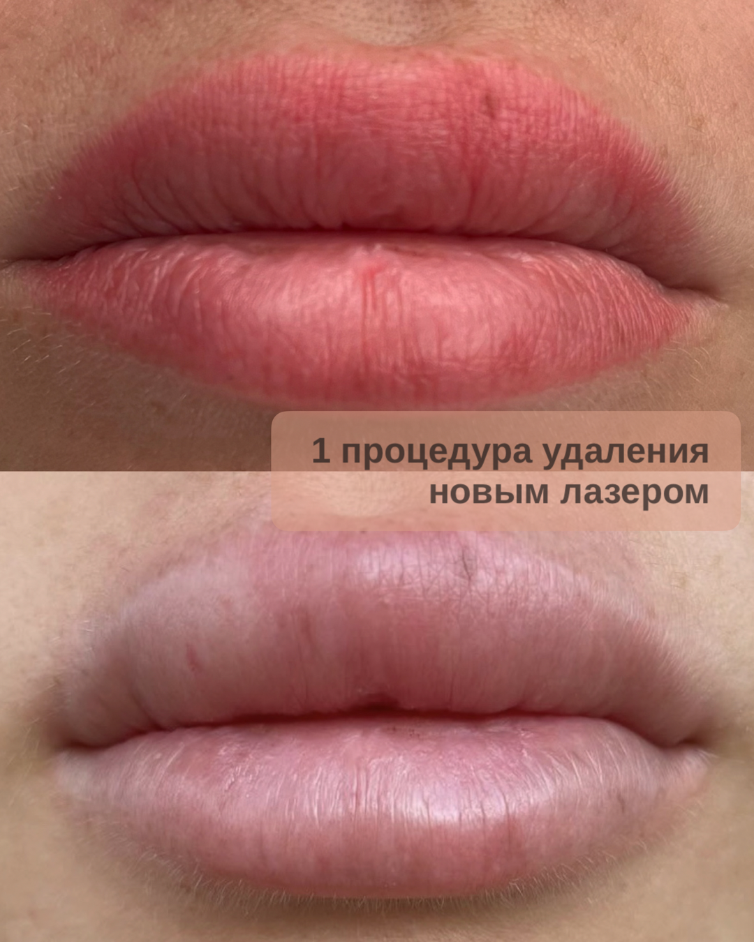 удаление татуажа лазером, удаление татуажа губ, удаление татуажа губ лазером, удаление татуажа, перманент губ