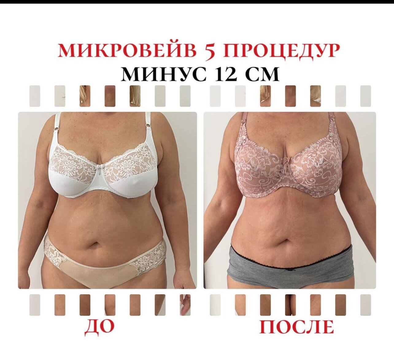 процедура криолиполиз, криолиполиз до и после, результаты, для похудения, коррекция фигуры