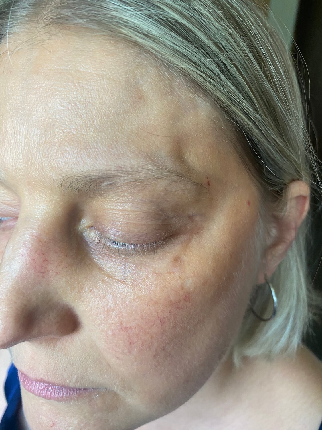 отек лица, под глазами, пилинг, блефаропластика, биоревитализация лица