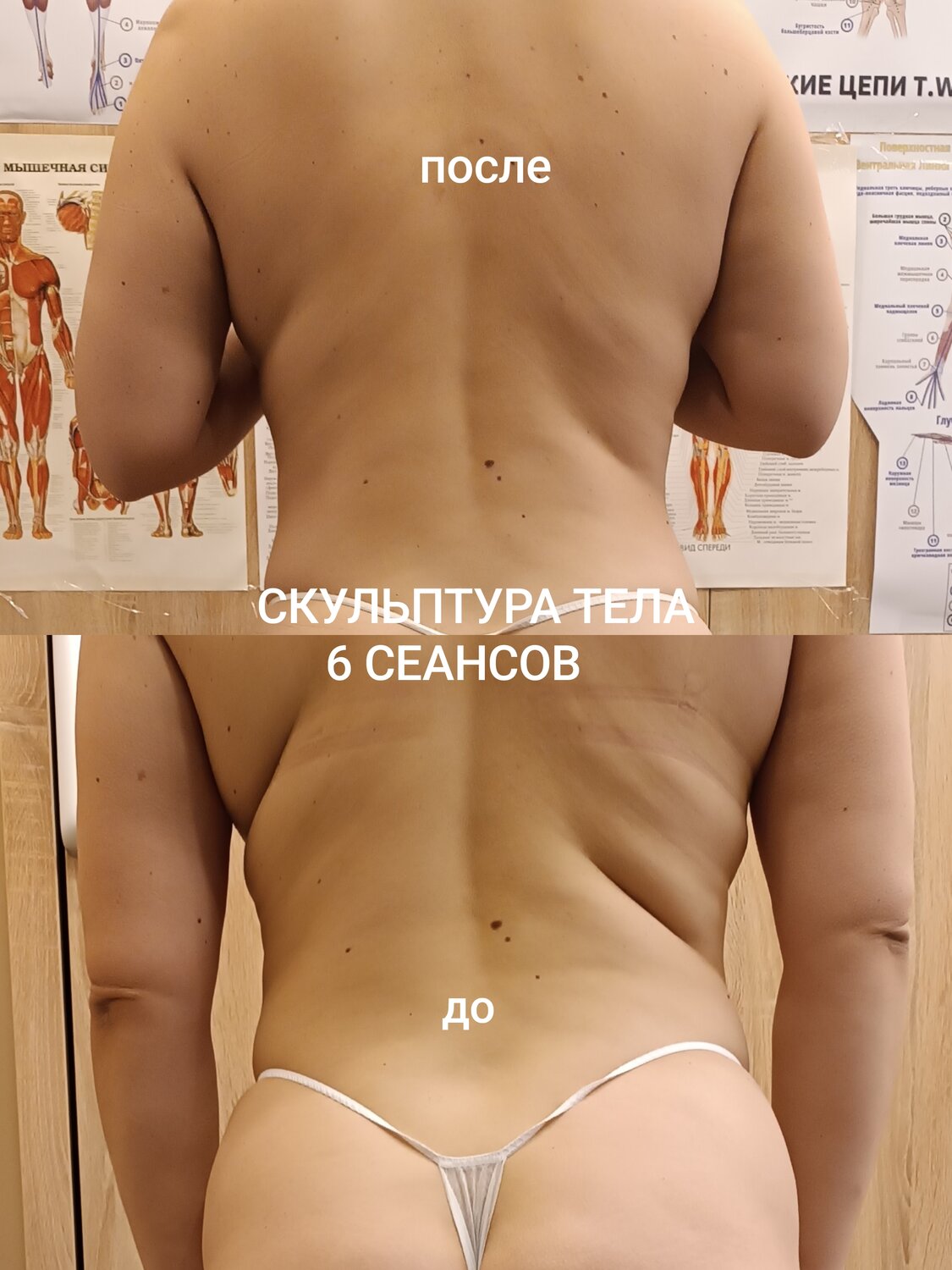 липомоделирование тела, липоскульптура тела, коррекция тела, коррекция фигуры, реконструкция тела