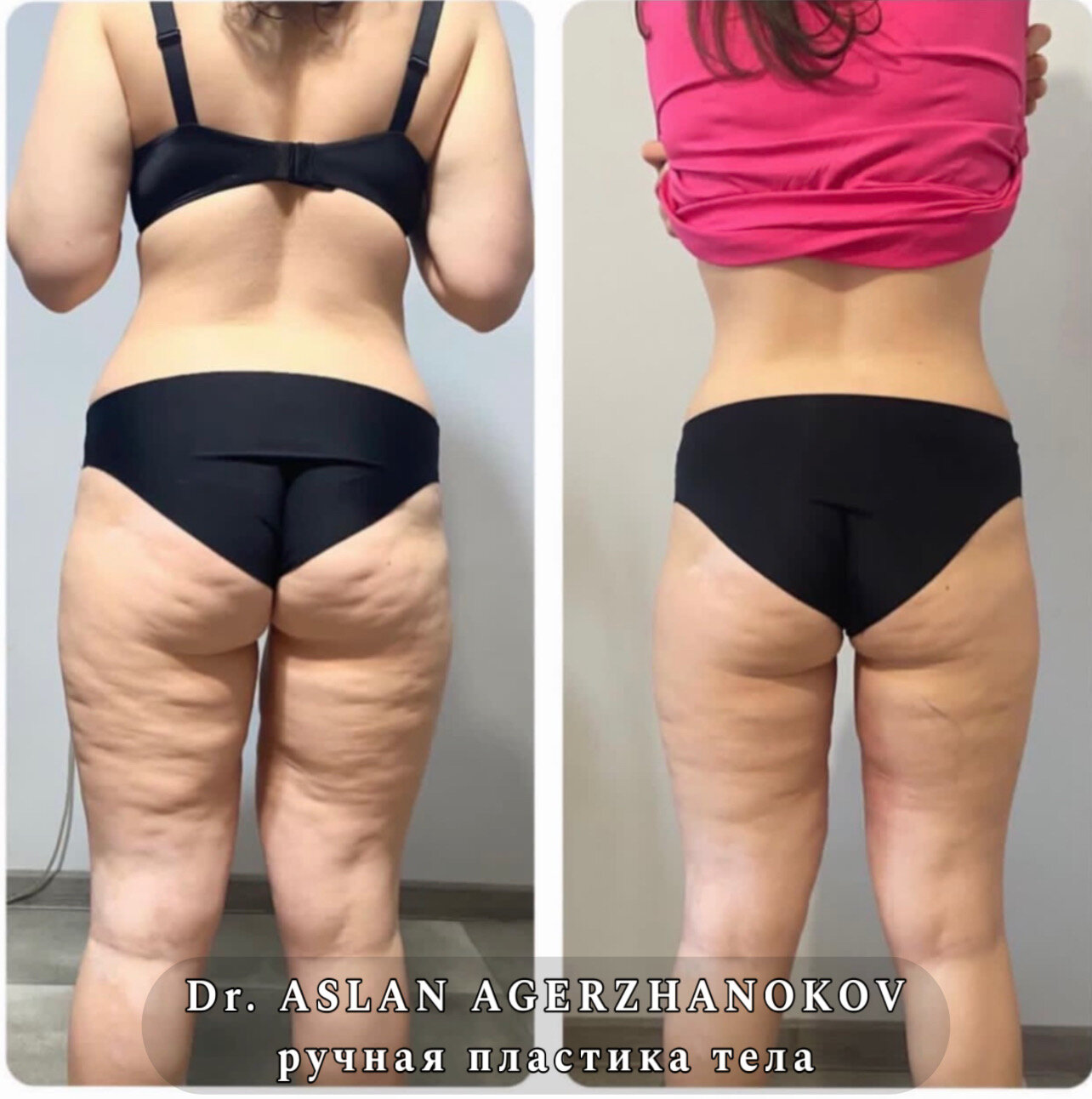 Антицеллюлитный массаж в Самаре Массаж Красота: 46 массажистов со средним ре