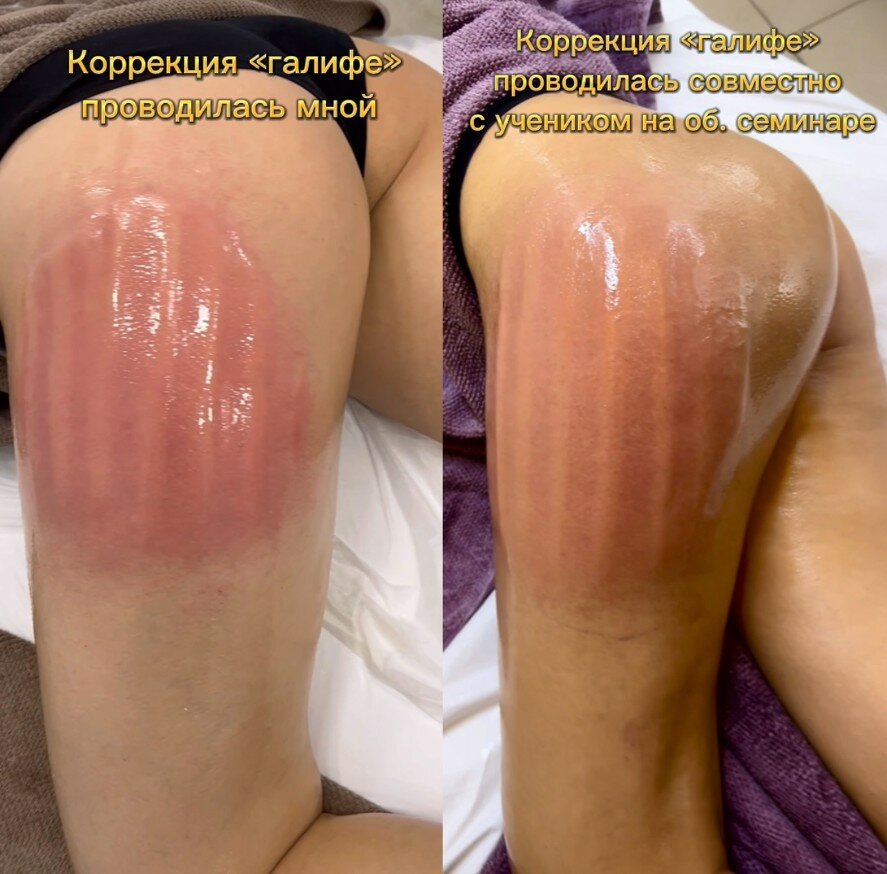восковая депиляция, сахарная депиляция, депиляция, шугаринг, шугаринг депиляция