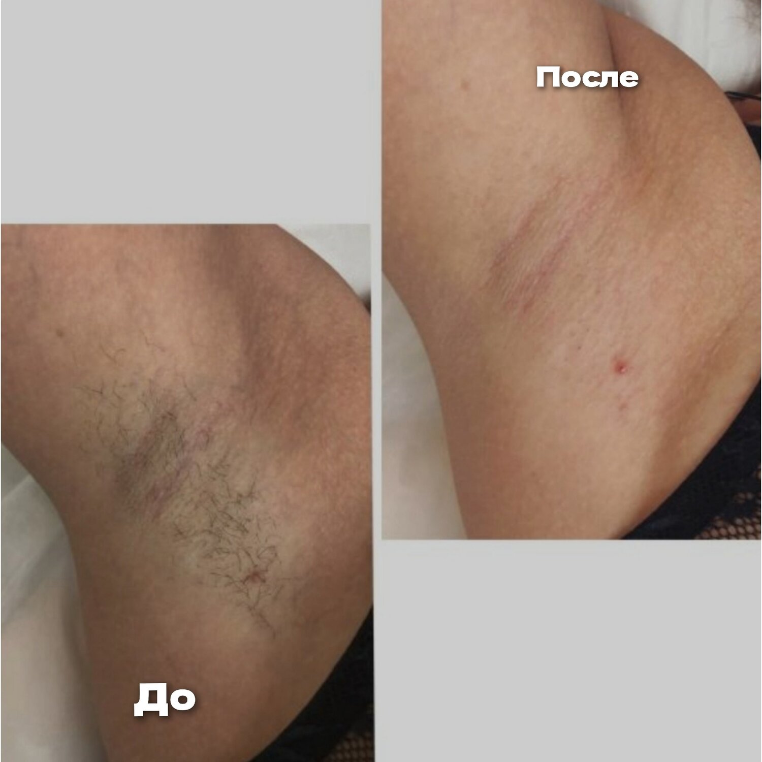 элос эпиляция, после лазерной эпиляции, результаты лазерной эпиляции, восковая эпиляция, лазерная эпиляция