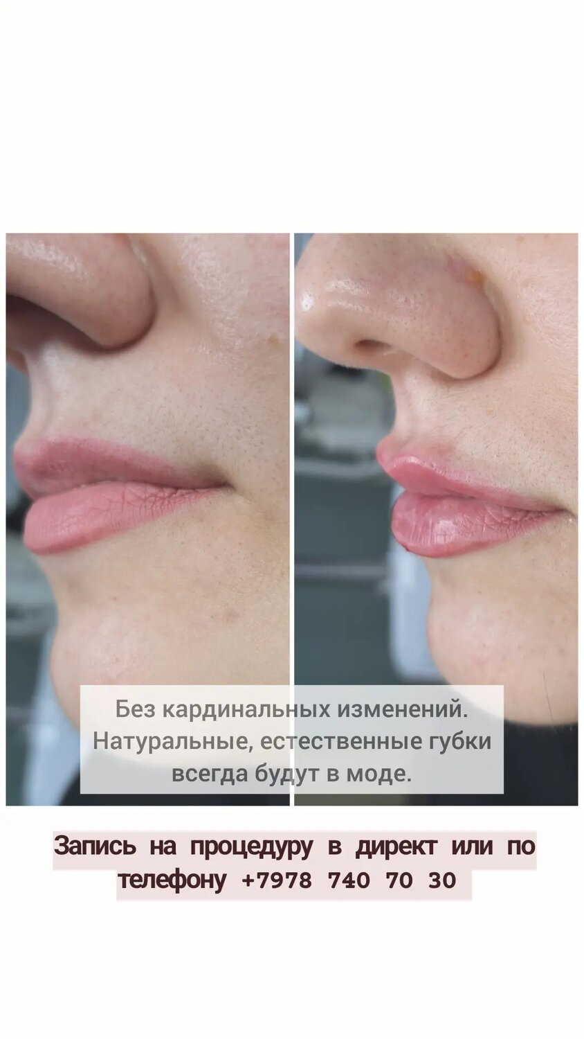 увеличение тонких губ, увеличение губ, процедура увеличения губ, губы гиалуроновой кислотой, пластика губ