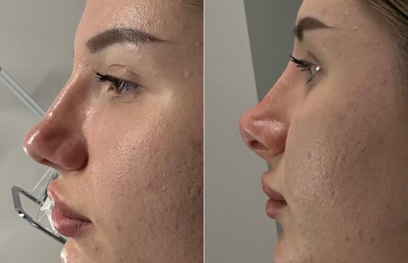 ринопластика носа, безоперационная ринопластика носа, безоперационная ринопластика филлерами, коррекция носа филлерами, пластика носа