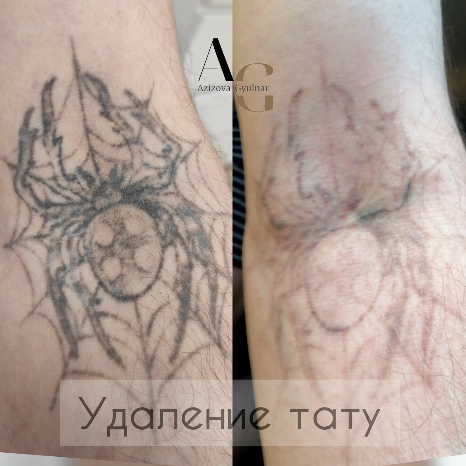 удаление тату лазером, лазерное удаление тату, удаление татуировки лазером, выведение татуировок, удаление татуировки