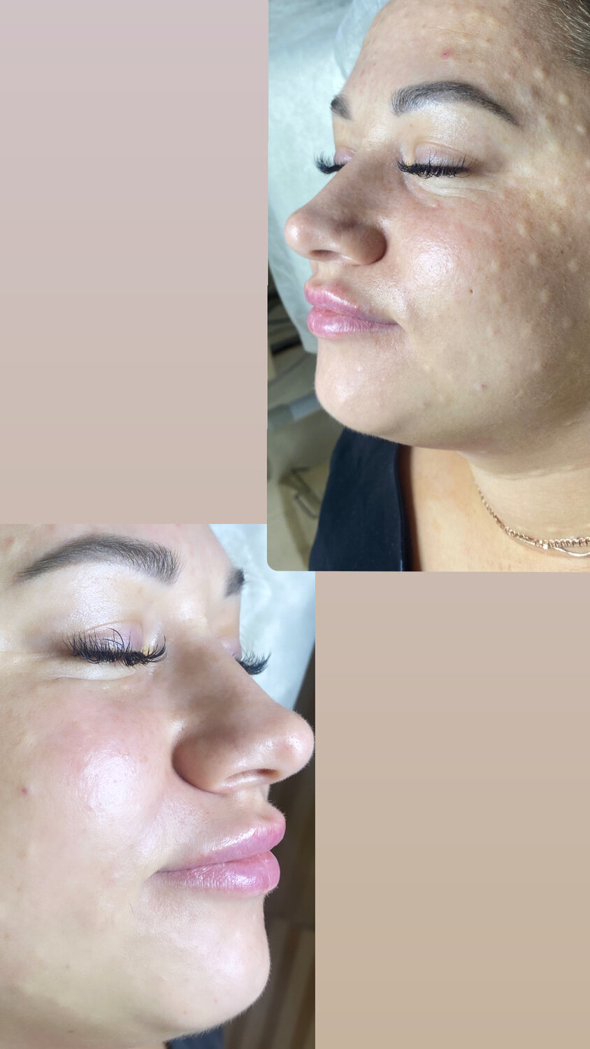 биоревитализация, эффект би би глоу, пилинг, мезотерапия акне дермапен, фракционная мезотерапия