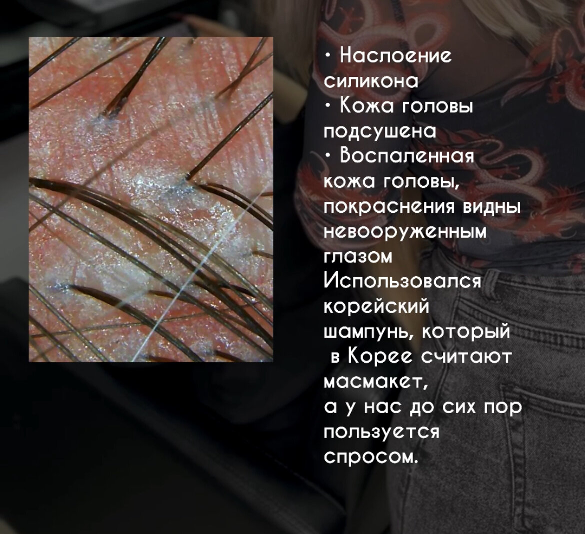 пилинг кожи головы, пилинг для волос и кожи головы, кожа головы, пилинг для кожи, кожа головы под трихоскопом