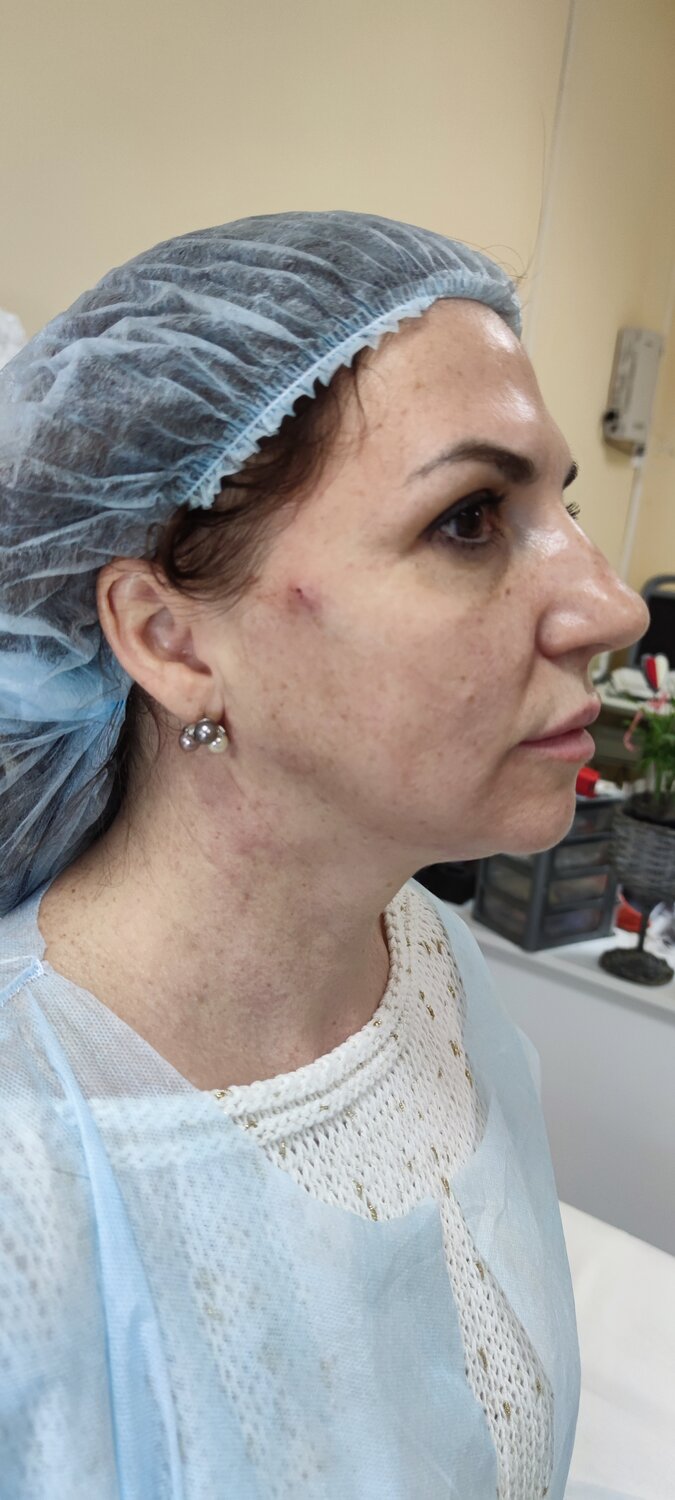 нитевой лифтинг аптос, нити коги для подтяжки лица, нити аптос для подтяжки лица, тредлифтинг золотые нити, нити для подтяжки лица
