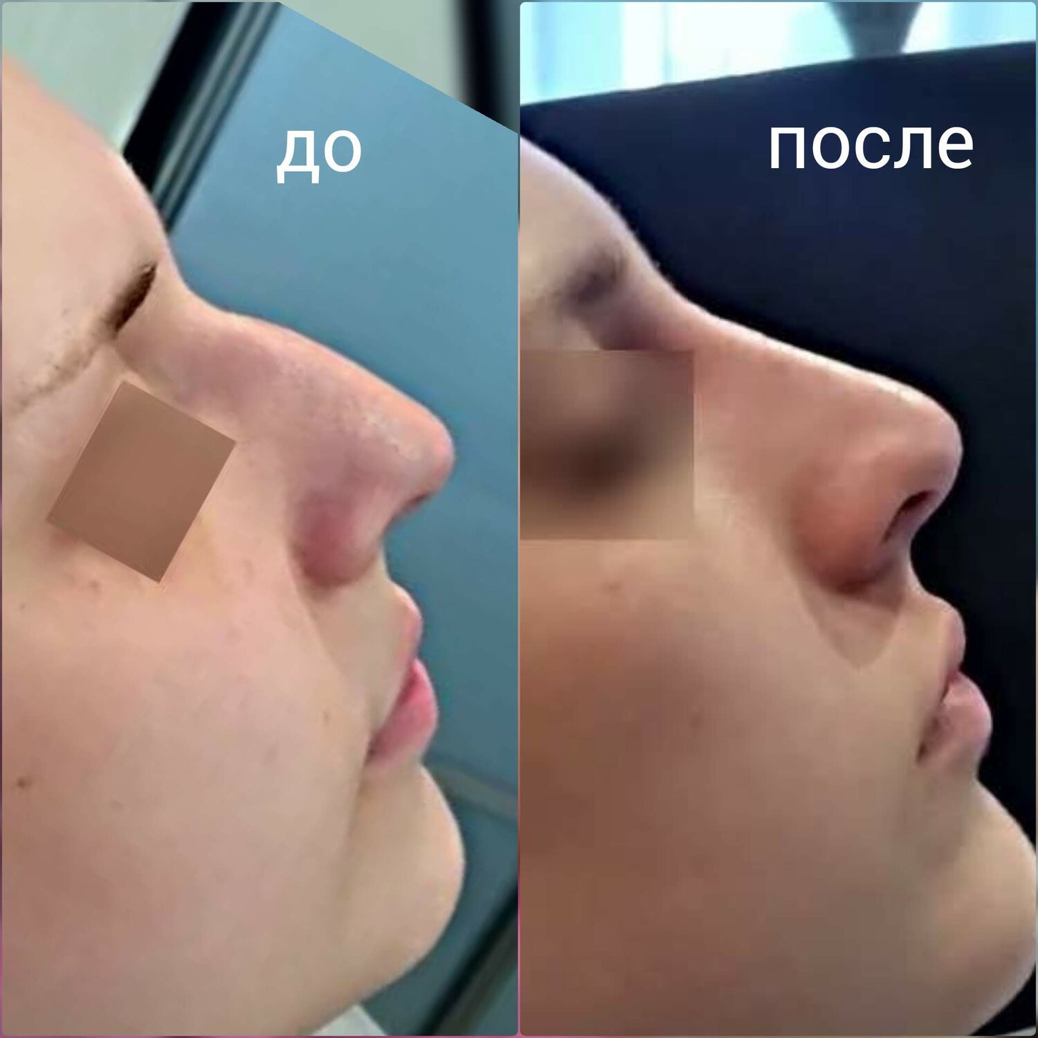 до и после, нестеренко ринопластика, после, часть лица, пластика носа омск