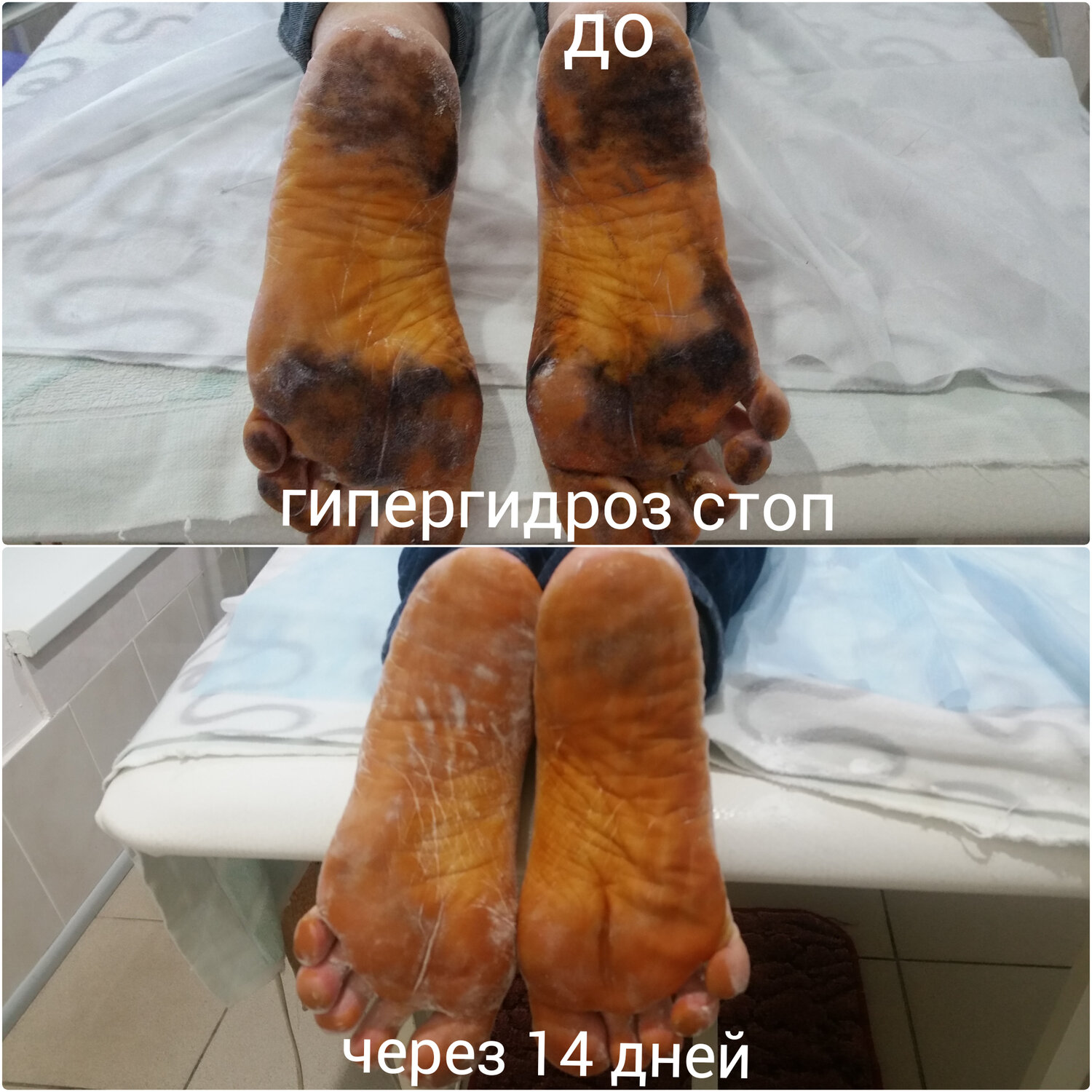 нога, гипергидроз, подошвенный гипергидроз, ног, грязные пятки