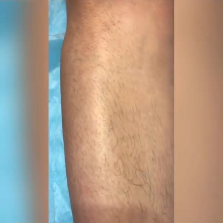 эпиляция, депиляция, лазерная эпиляция, фотоэпиляция, восковая эпиляция