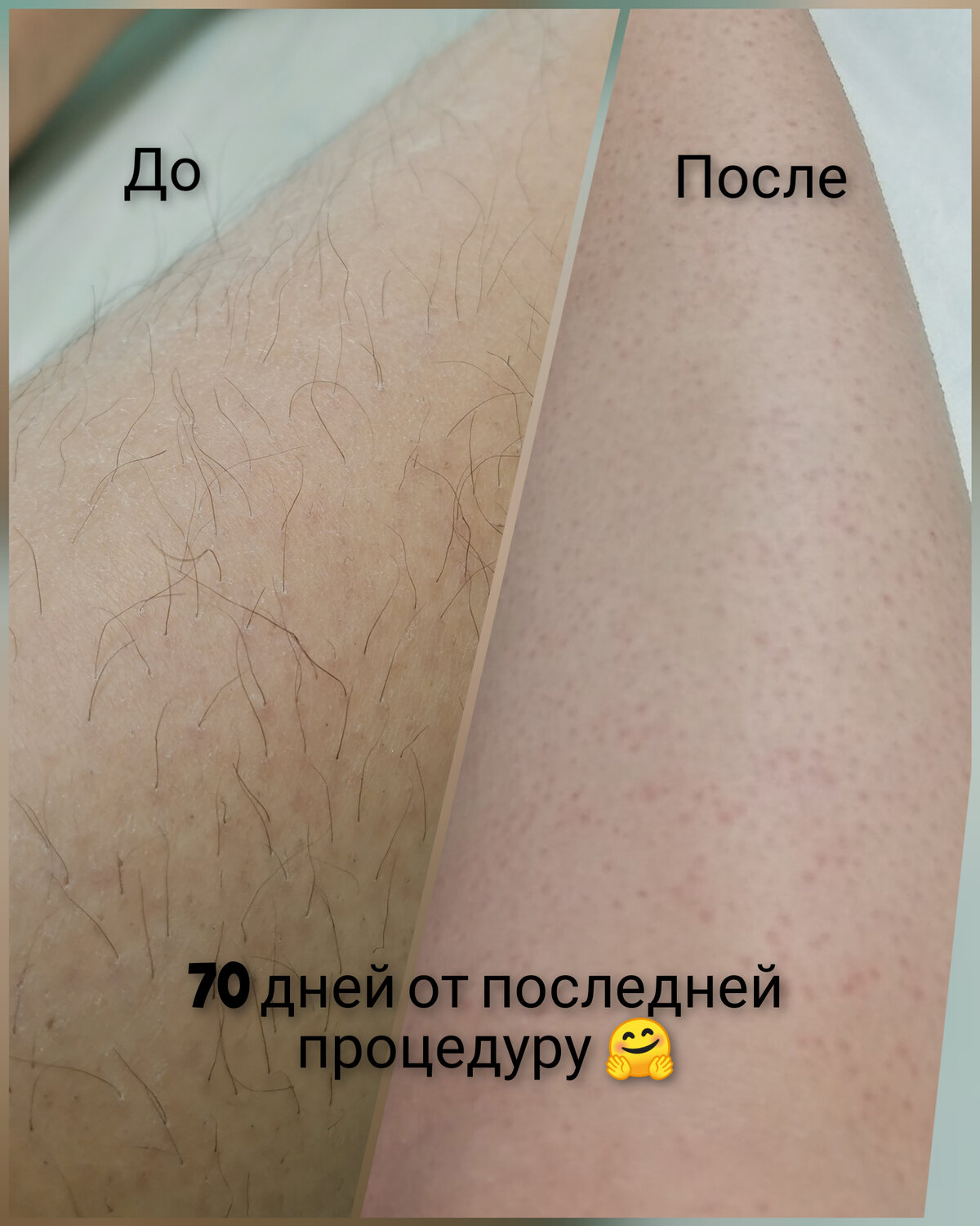 до и после шугаринга, шугаринг, скинс депиляция до после, лазерная эпиляция результат, восковая депиляция руки