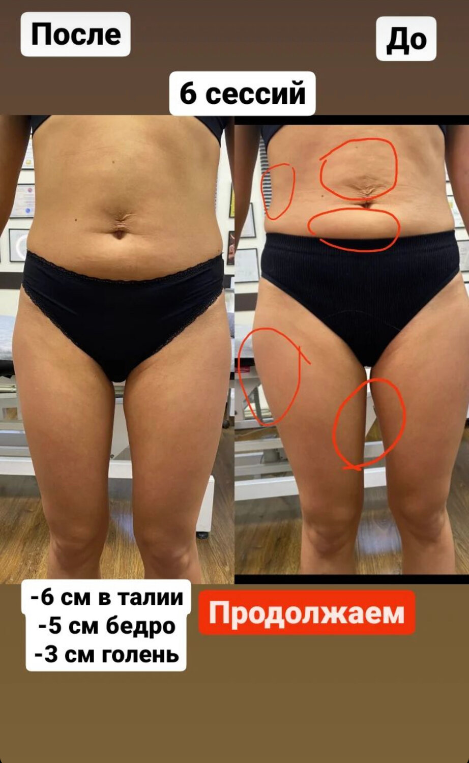 подтяжка бедер феморопластика, подтяжка бедер, пластика бедер, подтяжка внутренней поверхности бёдер, липосакция бедер