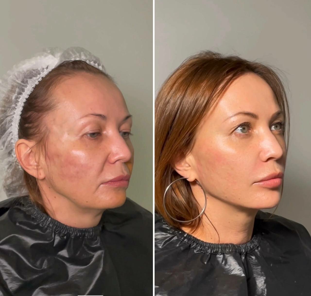 нитевой лифтинг, full face филлер, круговая подтяжка лица (фейслифтинг), смас лифтинг, нитевой лифтинг лица