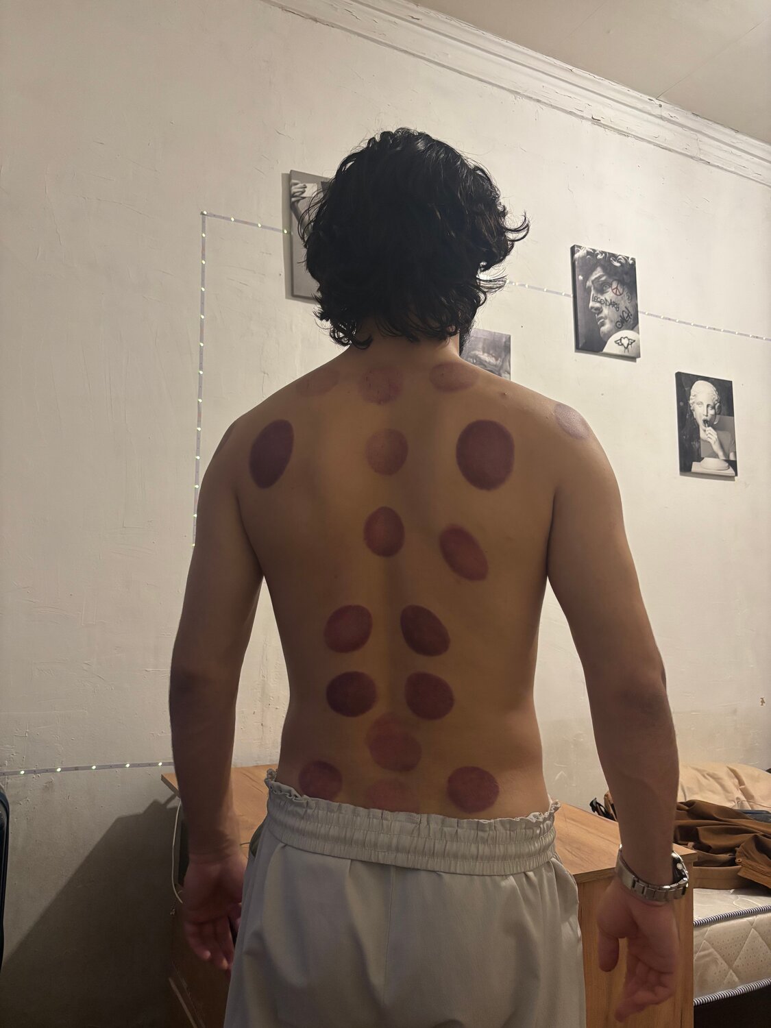 cupping marks, ��������������, ���������� ���� ����������, ���������� ��������������, �������������� ���� ����������