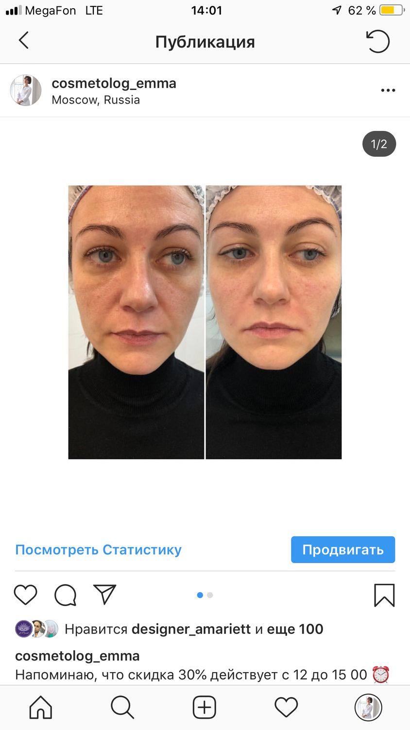 Филлеры с гиалуроновой кислотой