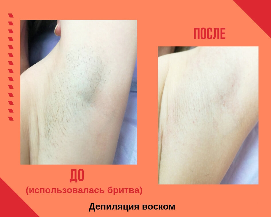 лазерная эпиляция, фотоэпиляция, шугаринг до и после, эпиляция, депиляция