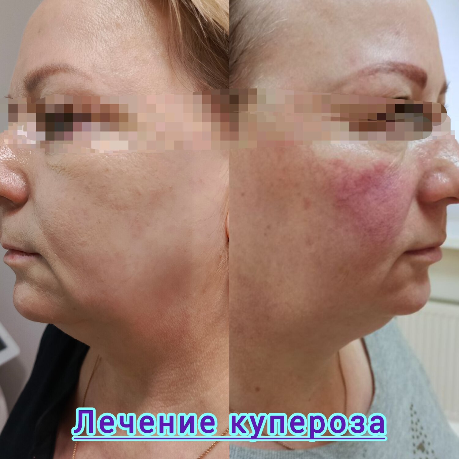лазерная дермабразия розацеа, акне и розацеа, петля груздева нитевой лифтинг, пластика верхнего века, фотоомоложение