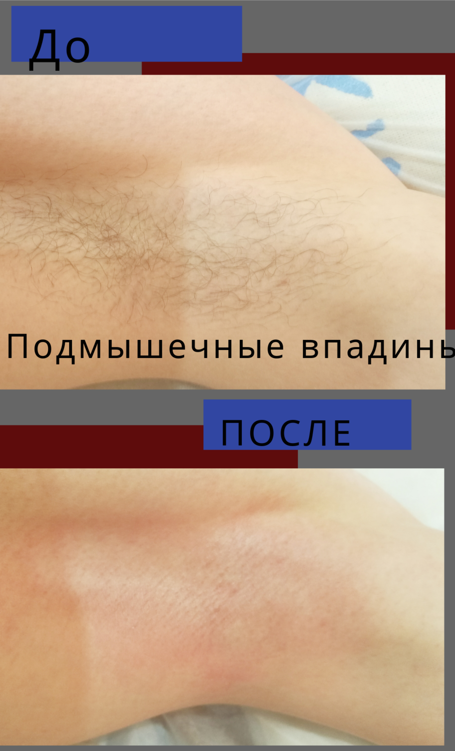 часть тела человека, эпиляция, лазерная эпиляция результат, эпиляция бикини классика, депиляция