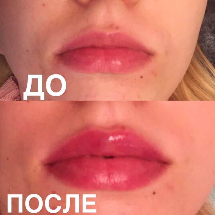 Контурная пластика в Москве - цены и 