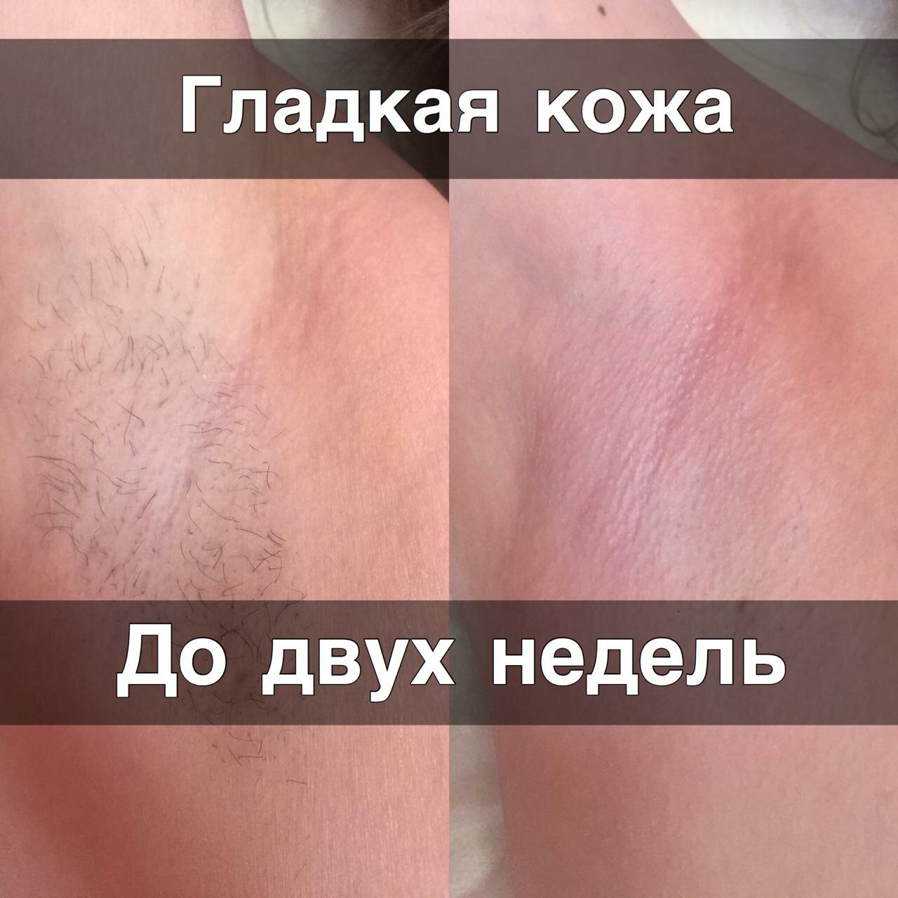 шугаринг, часть тела человека, депиляция, восковая эпиляция, эпиляция