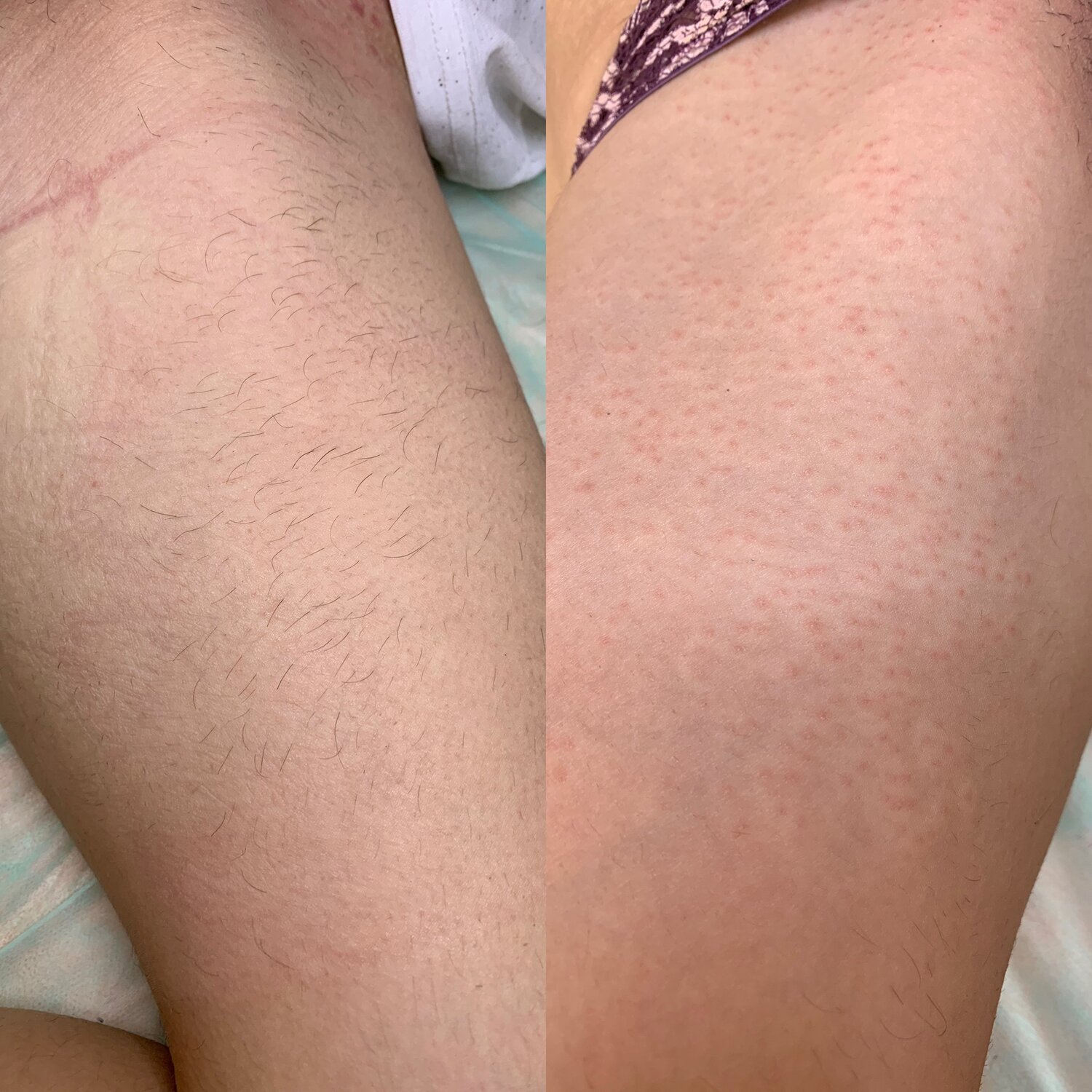 эпиляция, депиляция, красные полосы на ногах после фотоэпиляции, часть тела человека, шугаринг