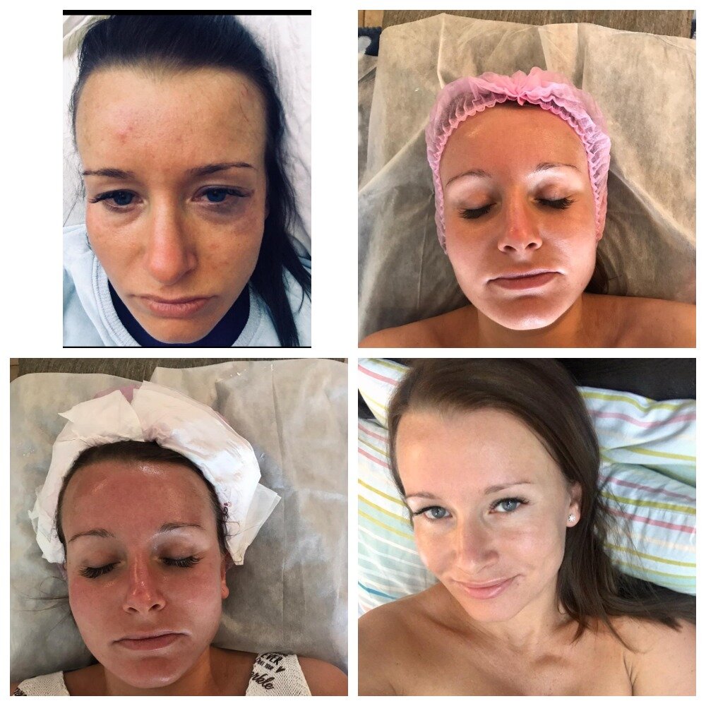 пилинг, процесс введения релатокса у косметолога, чистка лица, косметологии, мезотерапия лица