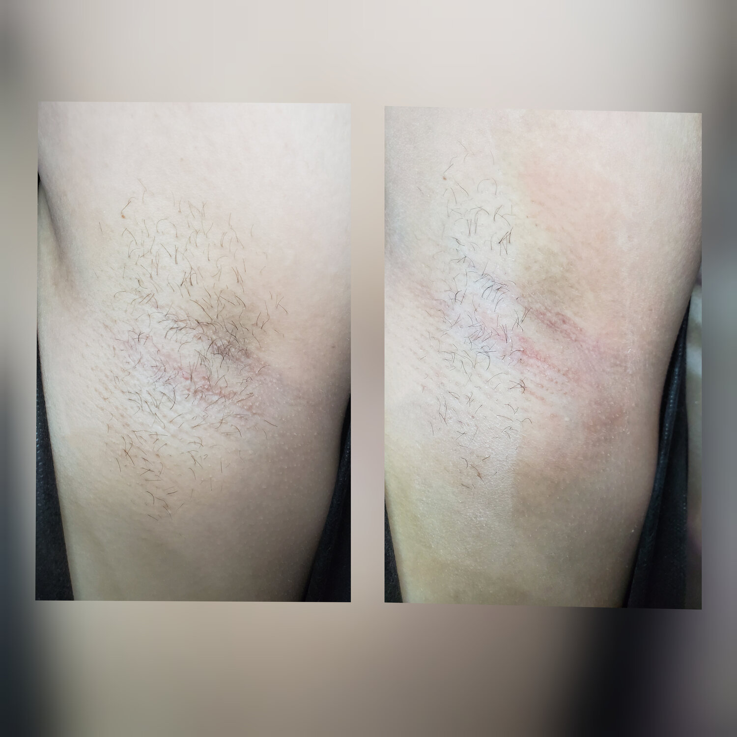 электроэпиляция, эпиляция, депиляция, лазерная эпиляция, лазерная эпиляция подмышек