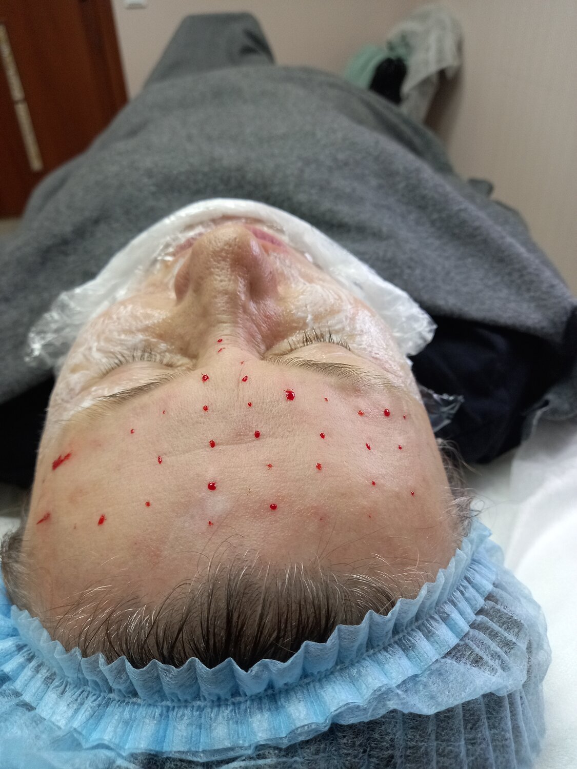лица, часть лица, капилляротерапия лица, мезотерапия лица, мезотерапия