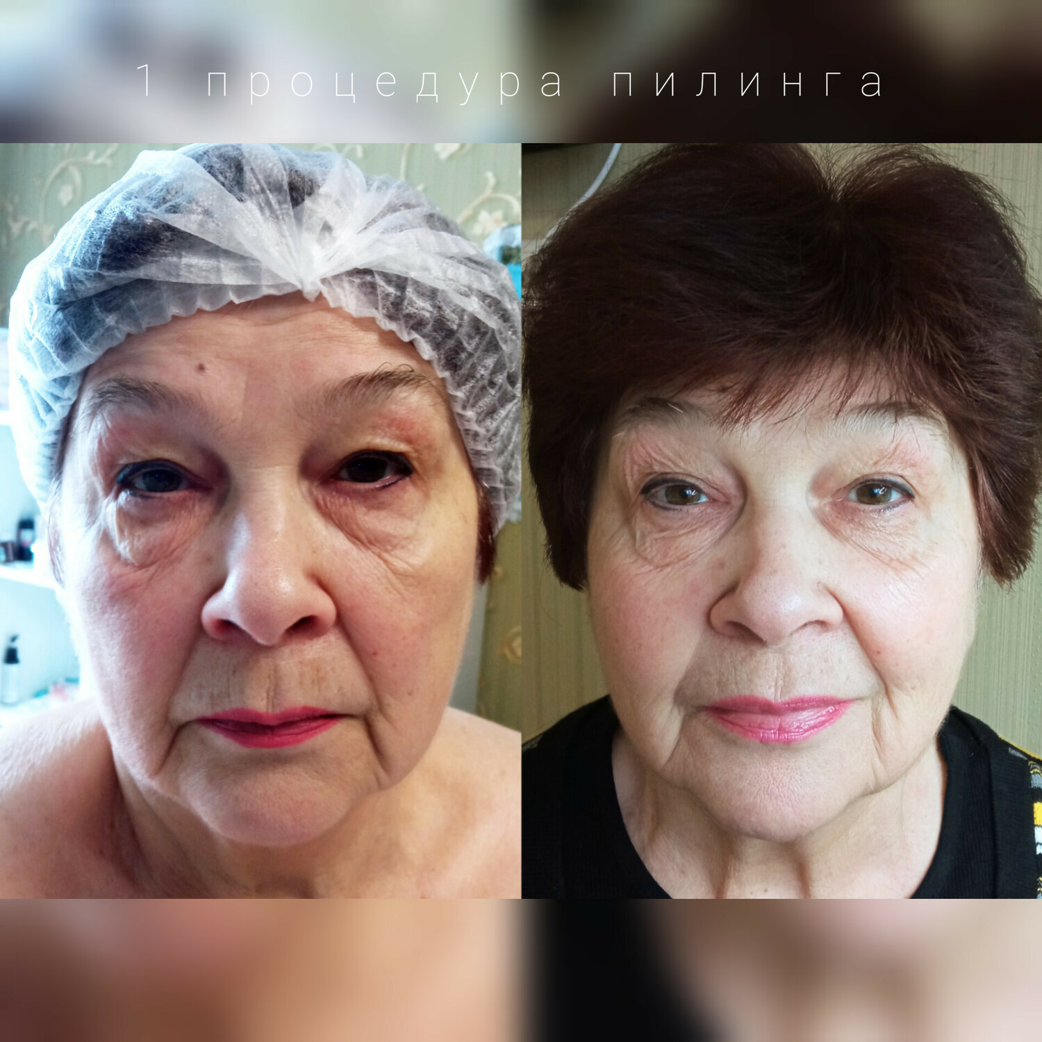 prp cortexil для лица когда виден эффект, лифтинг, smas лифтинг, женщина, омоложение