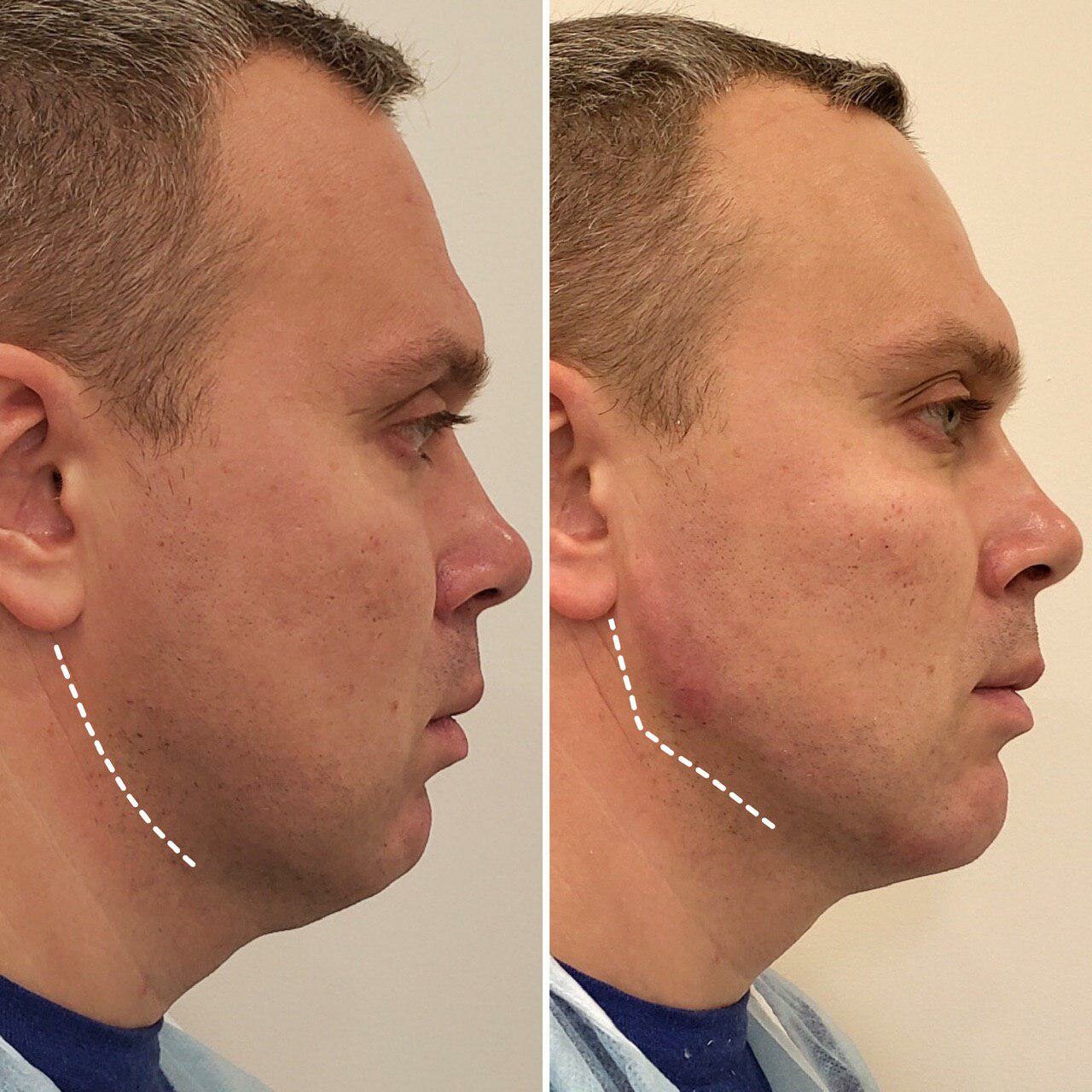 подтяжка подбородка у мужчин, лица, подбородок, часть лица, chin augmentation