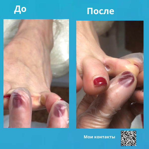 педикюр, медицинский педикюр, кандидозный онихомикоз, педикюр классический, педикюр без покрытия