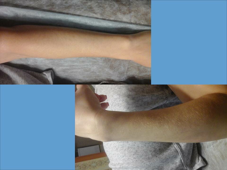 шугаринг рук, депиляция рук, депиляция, эпиляция рук, часть тела человека