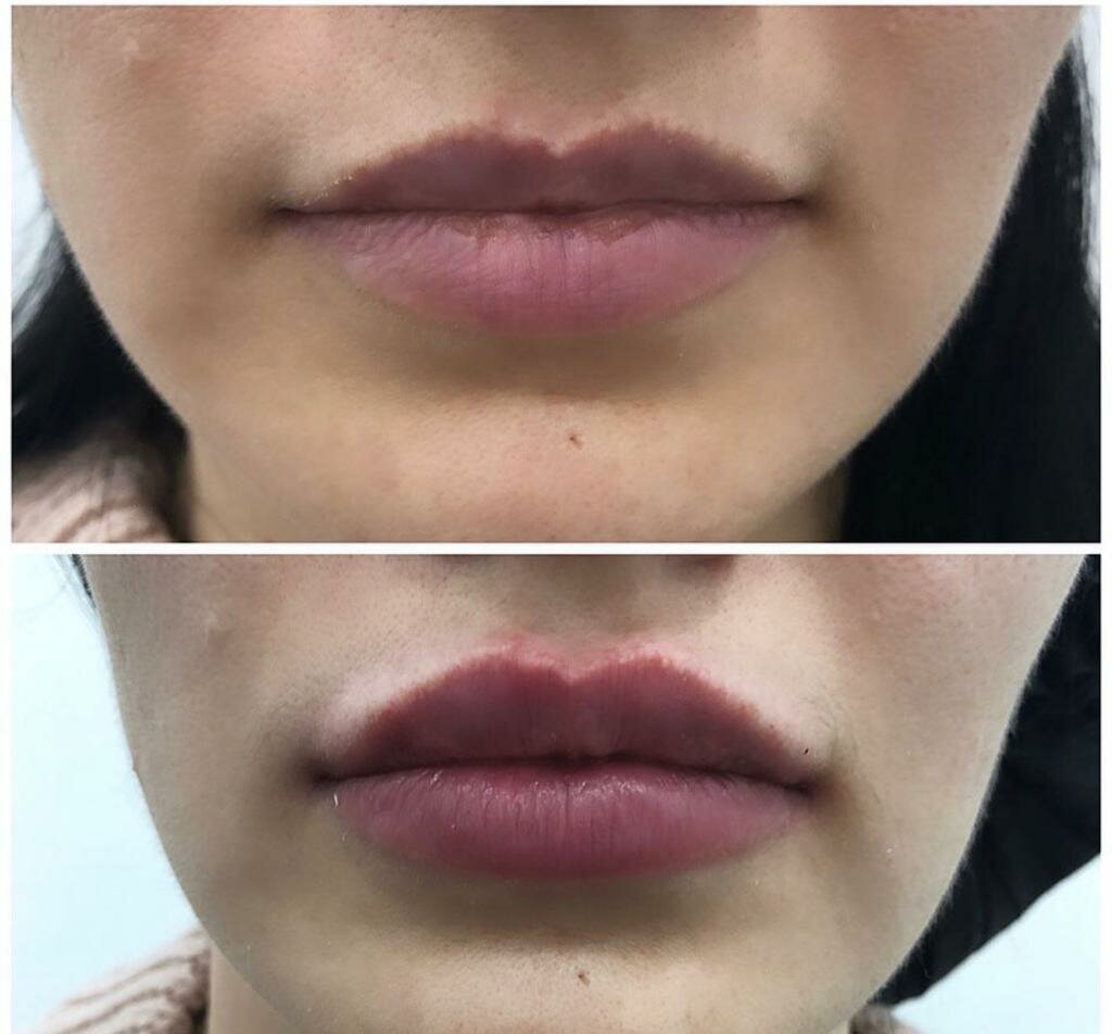 увеличение губ гиалуроновой кислотой 1, увеличение губ, исправление формы губ филлером, коррекция губ, четкий контур губ филлером