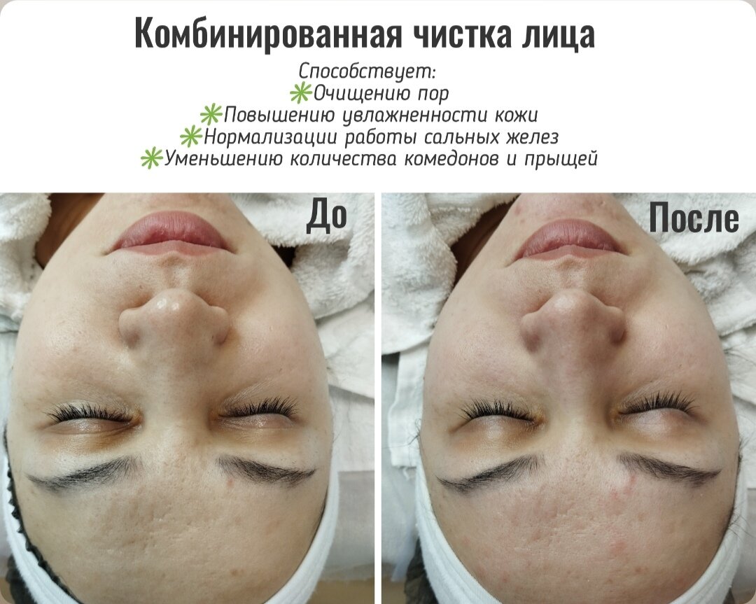 пилинг лица, чистка лица, пилинг, я косметолог, услуги косметолога