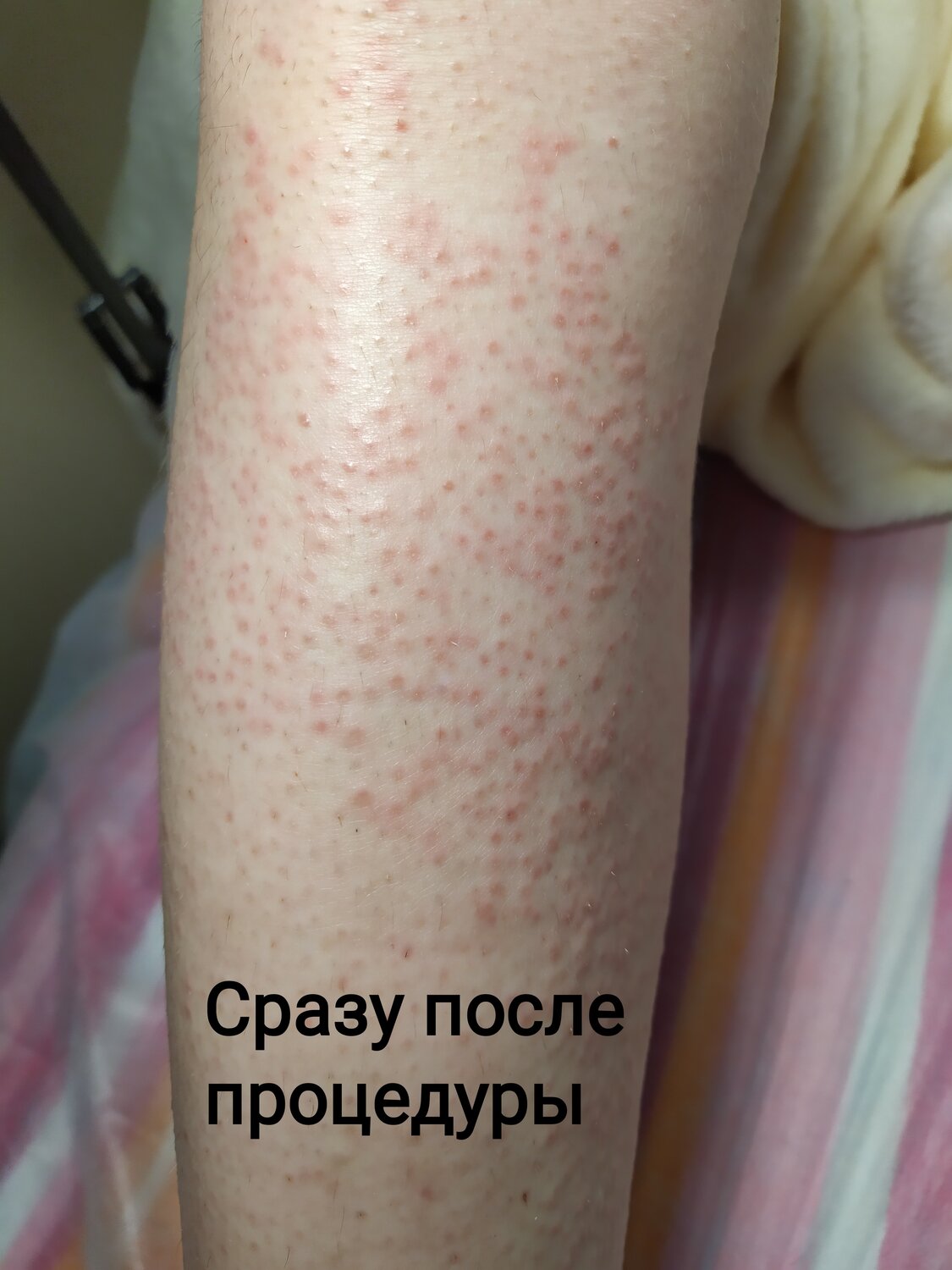 часть тела человека, электроэпиляция, аллергический дерматит, сыпь на ногах после эпиляции, сыпь на руках