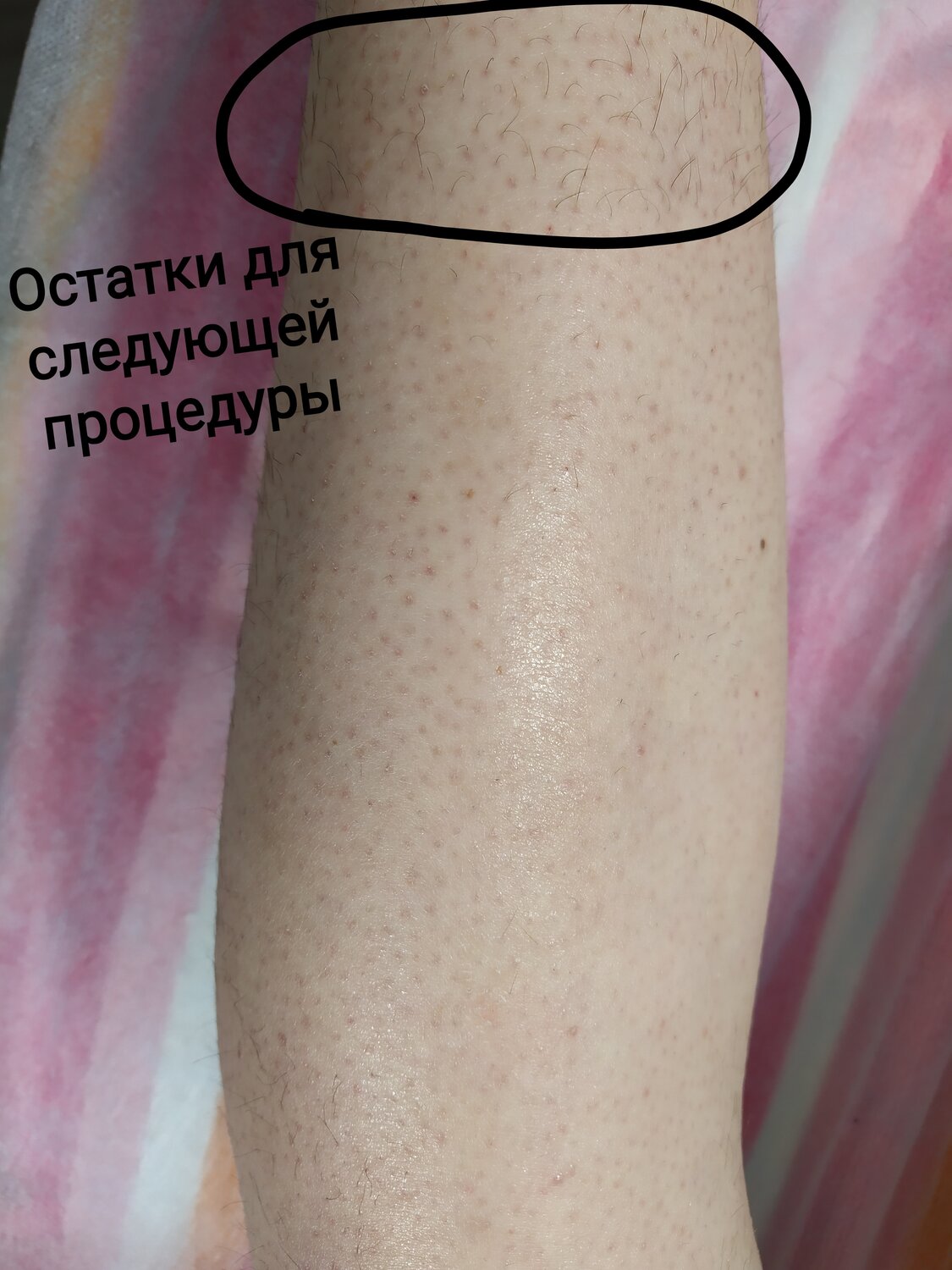 электроэпиляция, часть тела человека, эпиляция, электроэпиляция голени, процедура