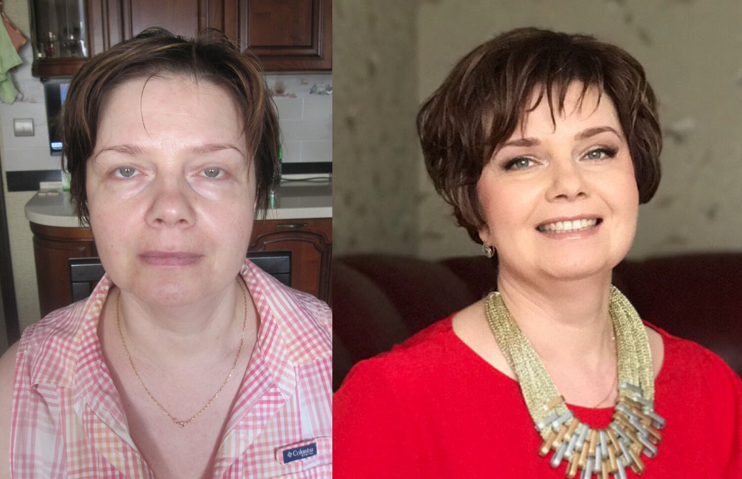 женщина, человек, подтяжка лица, эндоскопическая подтяжка лица якимец, лица