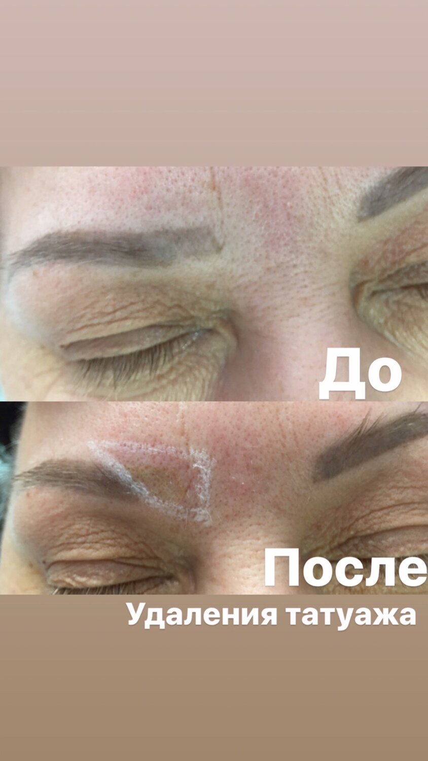татуаж, удаление татуажа визитка, коррекция татуажа ремувером, коррекция татуажа бровей лазером, старый татуаж