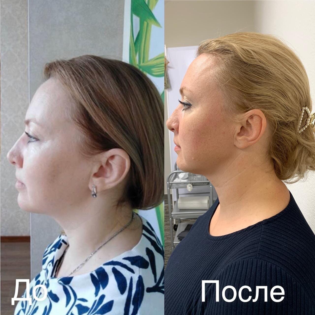 девушка, лица, нити в подбородок, женщина, подбородок