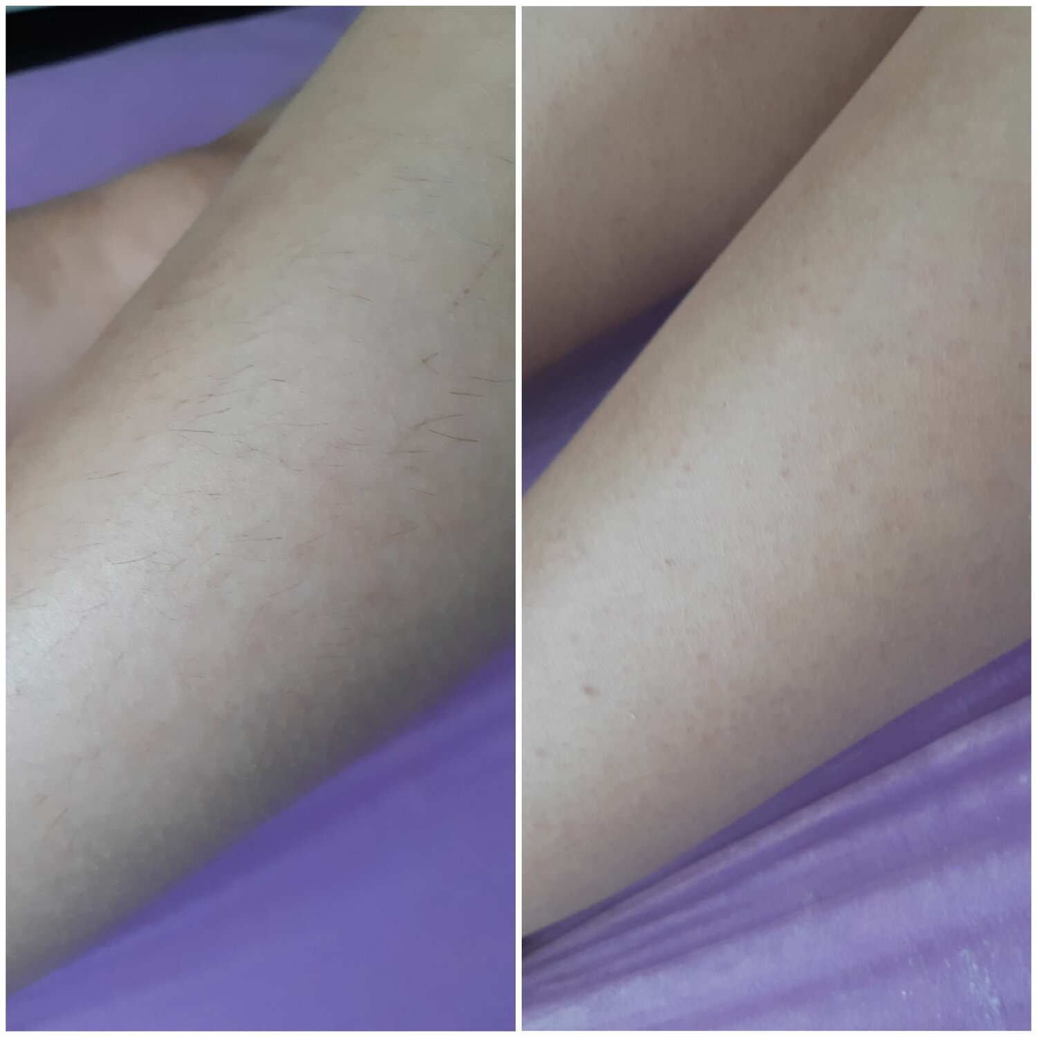 депиляция, шугаринг, эпиляция, часть тела человека, восковая эпиляция подмышек