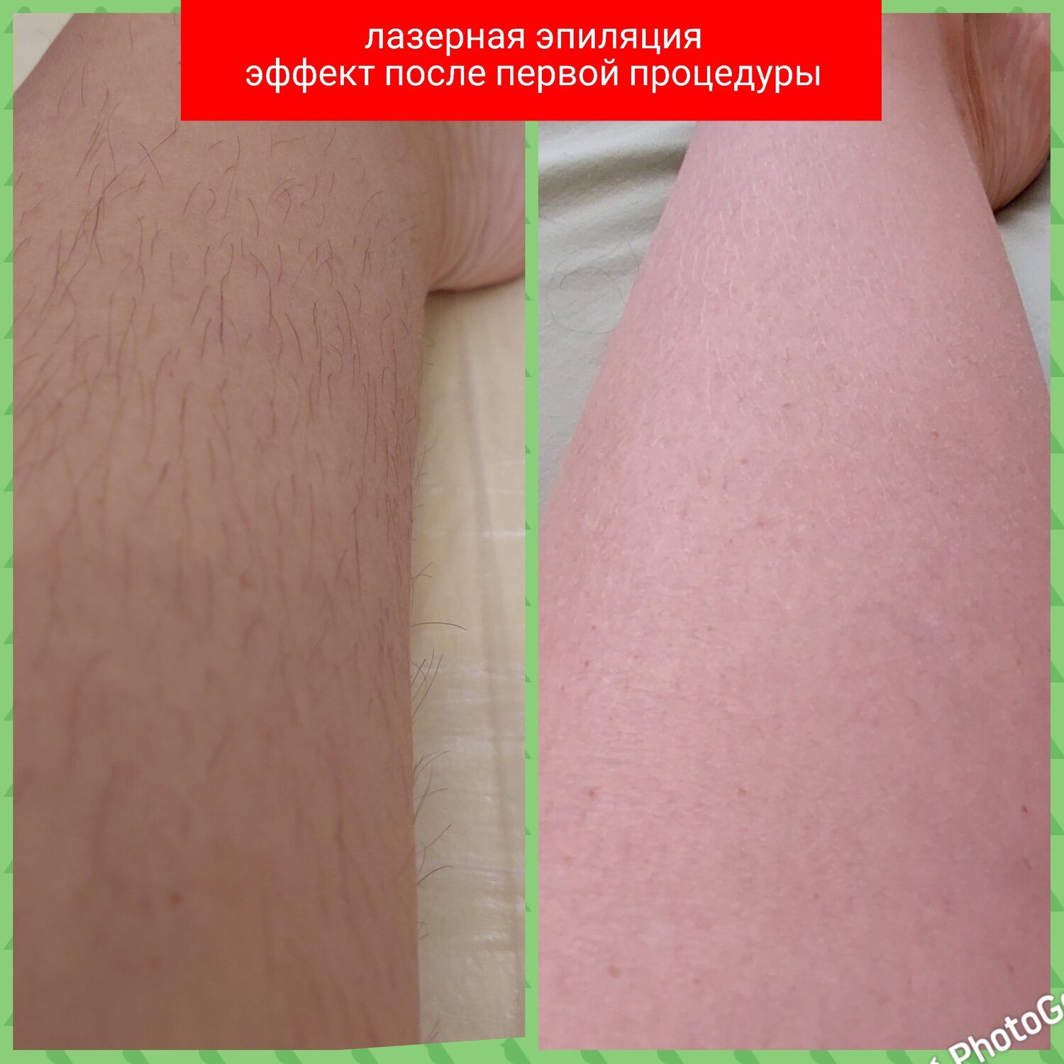шугаринг депиляция, шугаринг, эпиляция, шугаринг ног, восковая депиляция